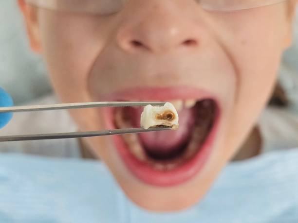 Best Pediatric Emergency Dentist in Mount Vernon, IA